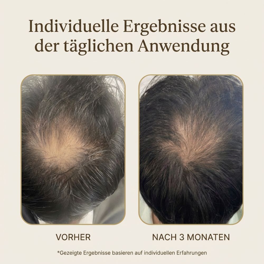 Azerum Premium Kopfhautserum Ergebnis: Vorher-Nachher nach 3 Monaten – dichteres Haar durch tägliche Anwendung
