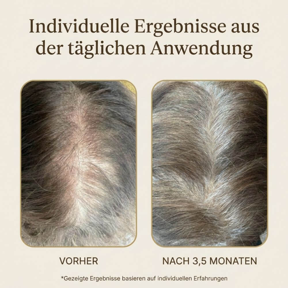 Vorher-Nachher-Vergleich nach 3,5 Monaten täglicher Anwendung von Azerum Premium Kopfhautserum – sichtbar dichteres Haar und reduzierter Haarausfall
