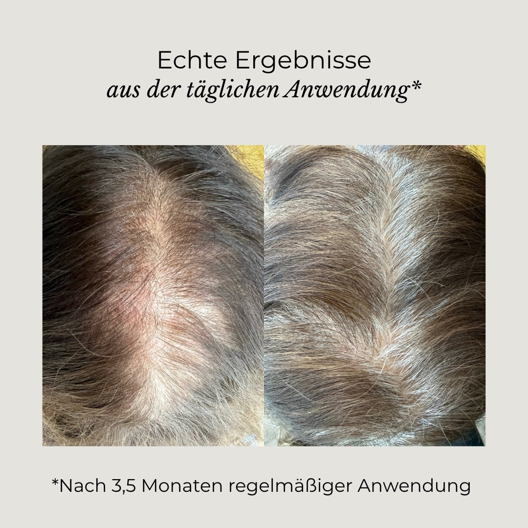 Vorher-Nachher-Bild des AZERUM Kopfhautserums für sichtbar dichteres Haar, zeigt Haarverdichtung und gesunde Kopfhaut