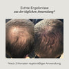 Vorher-Nachher-Bild eines Azerum Kopfhautserums für sichtbar dichtere Haare, zeigt Haarverdichtung und Haargesundheit.