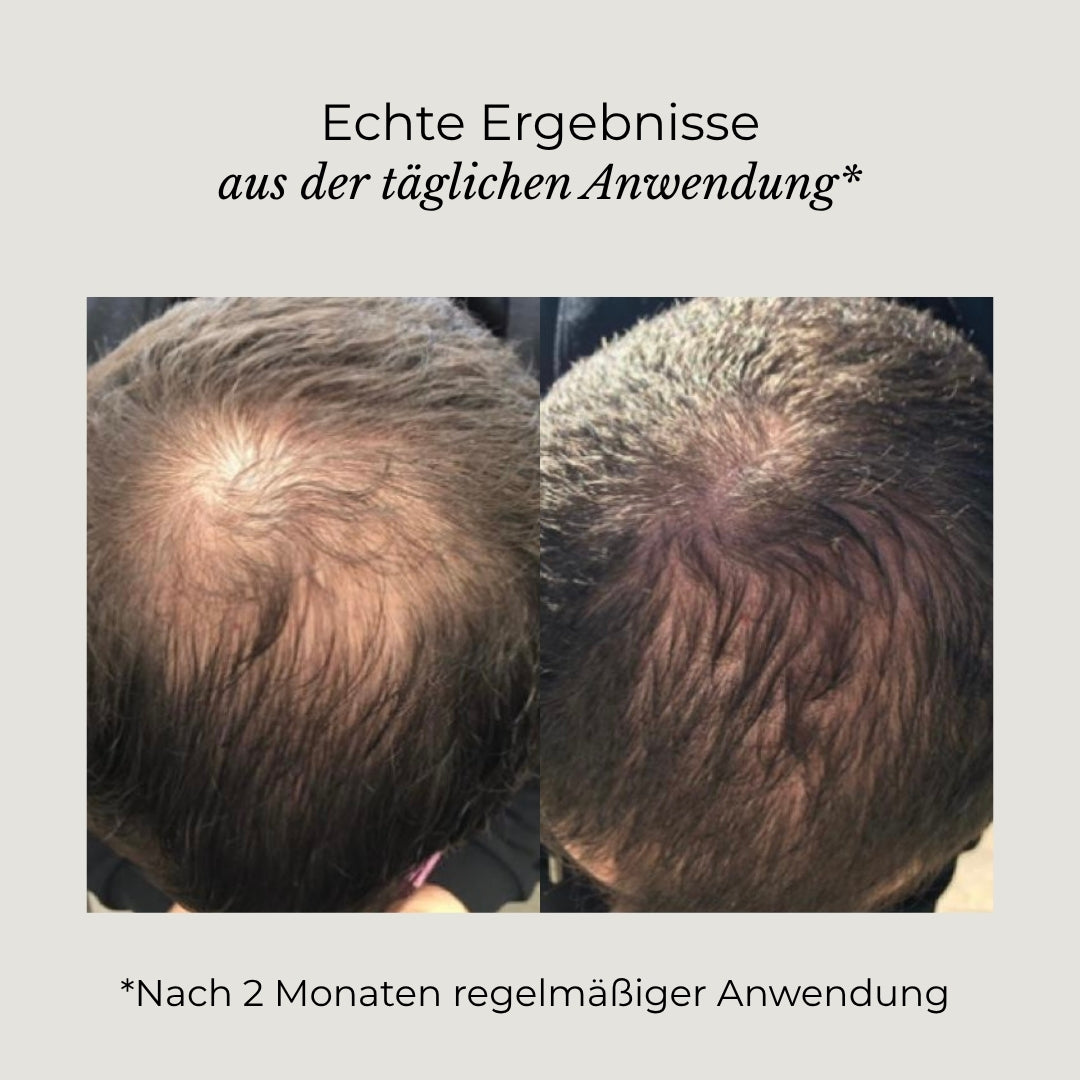 Vorher-Nachher-Bild eines Azerum Kopfhautserums für sichtbar dichtere Haare, zeigt Haarverdichtung und Haargesundheit.