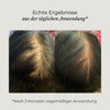 Vorher-Nachher-Bilder eines AZERUM Kopfhautserums für sichtbar dichteres Haar, zeigt Haarverdichtung und Kopfhautverbesserung