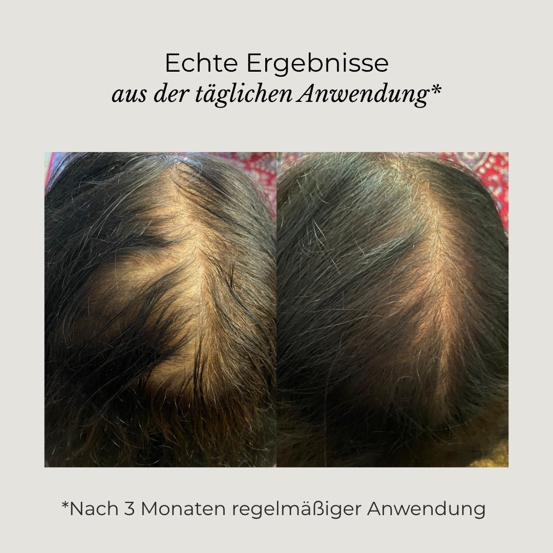 Vorher-Nachher-Bilder eines AZERUM Kopfhautserums für sichtbar dichteres Haar, zeigt Haarverdichtung und Kopfhautverbesserung
