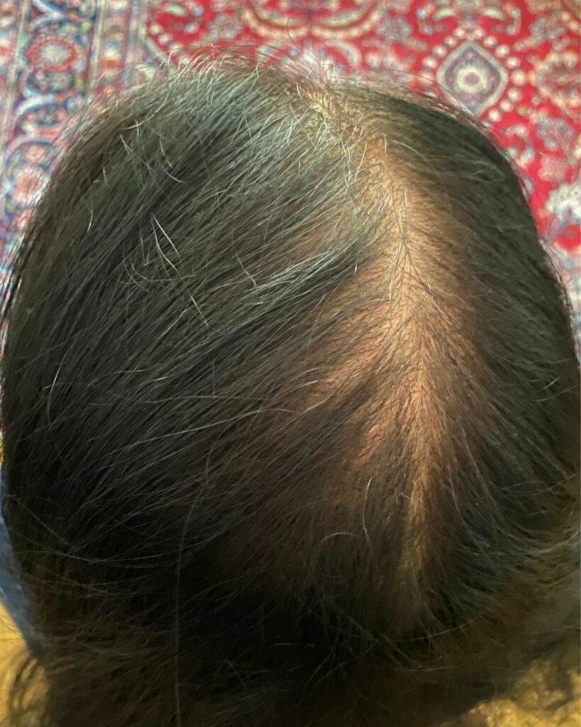 Nachher-Bild einer Azerum-Kundin mit deutlich dichterem und gesünderem Haar nach der Behandlung. | Azerum Hair