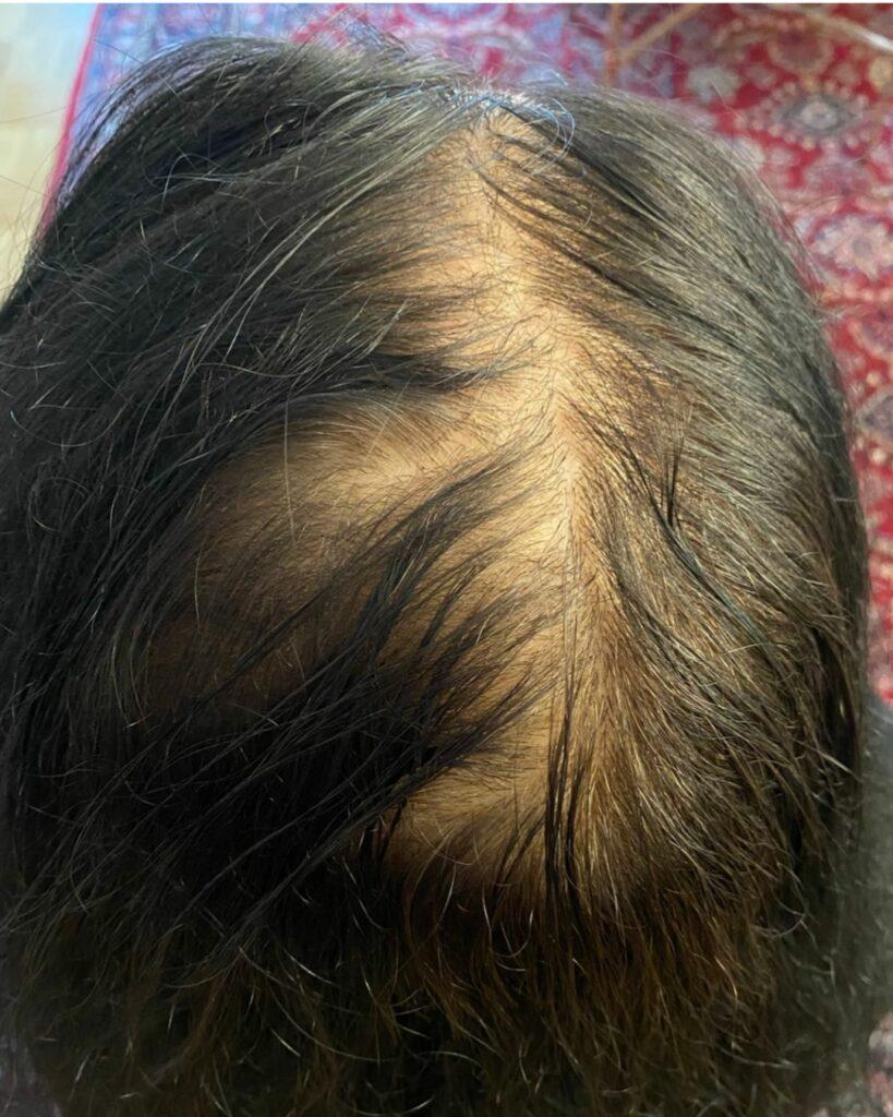 Vorher-Bild einer Frau mit sichtbar schütterem Haar, Kundin vor der Behandlung mit Azerum Haarserum, kämpft mit Haarausfall. | Azerum Hair