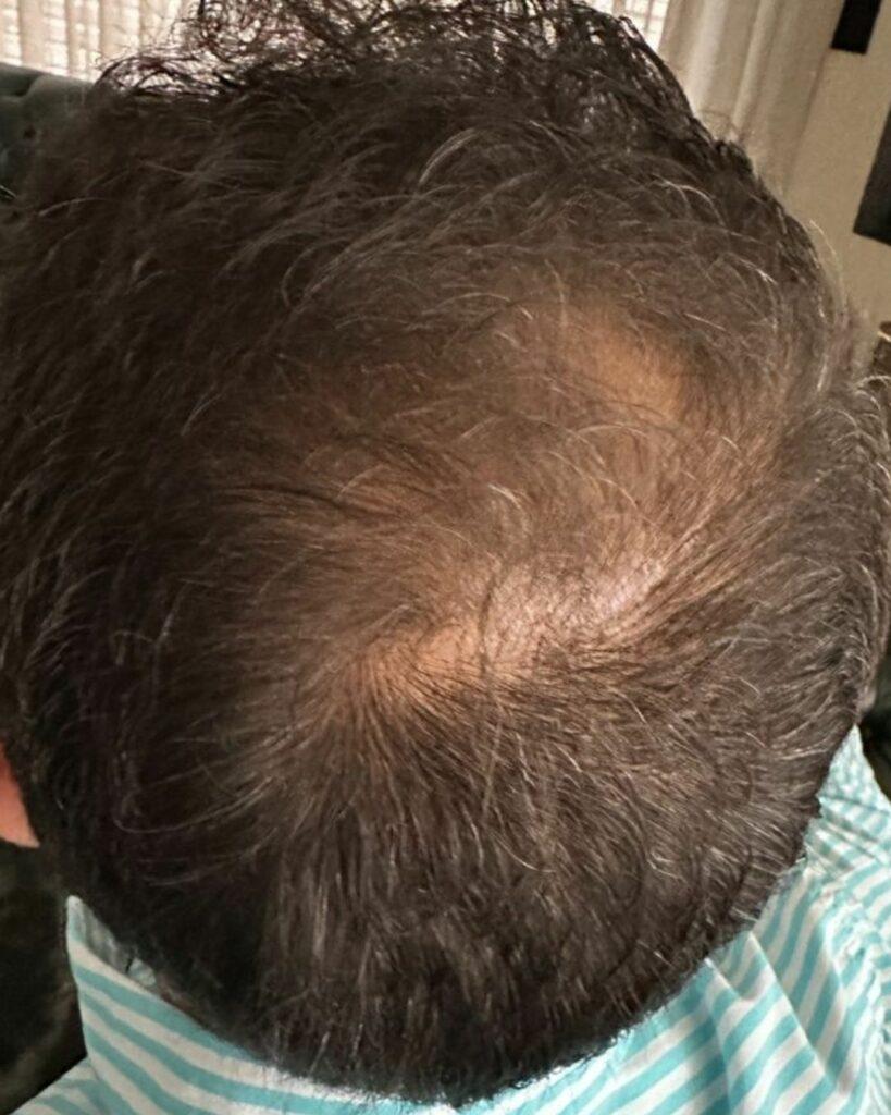 Mann mit sichtbar schütterem Haar am Oberkopf, zeigt die Ausgangslage vor der Behandlung mit Azerum. | Azerum Hair