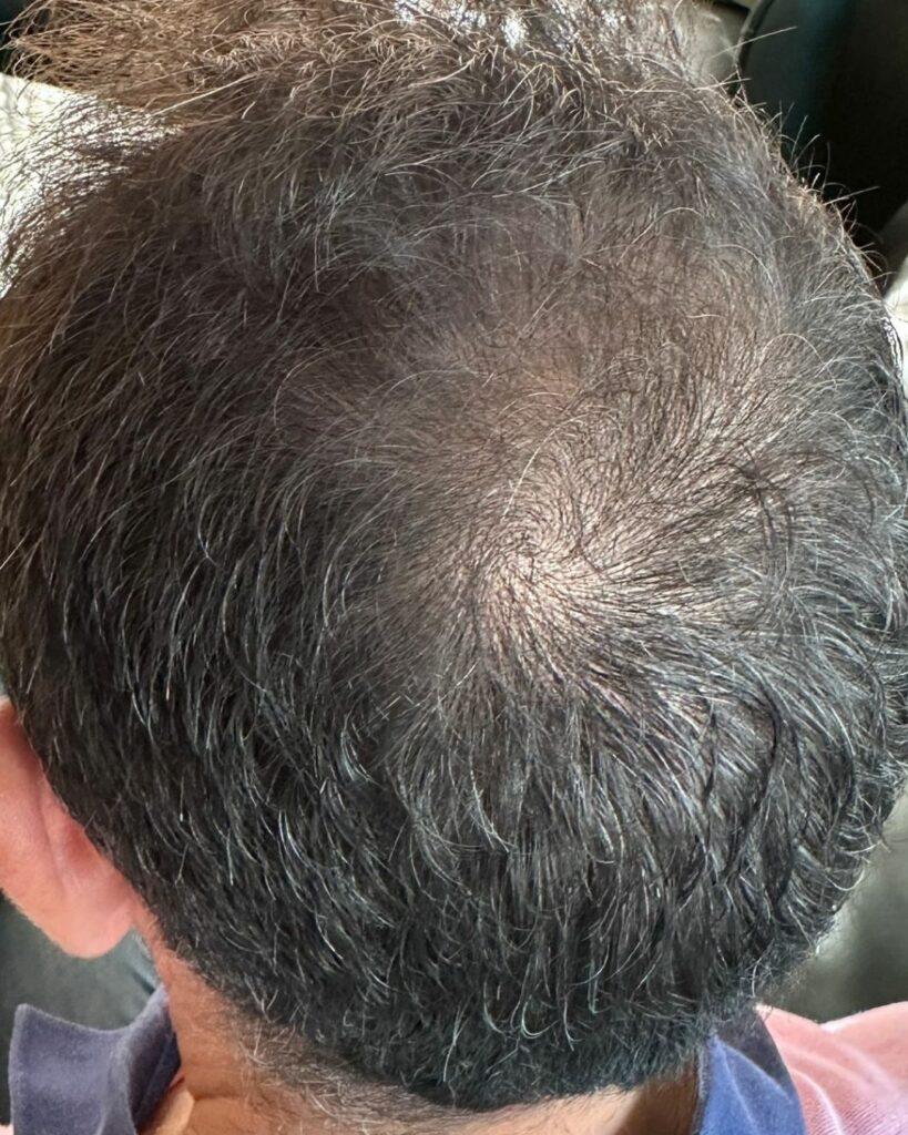 Nachher-Bild eines Mannes mit sichtbarer Haarverdichtung und gesünderem Haar nach Azerum-Behandlung. | Azerum Hair