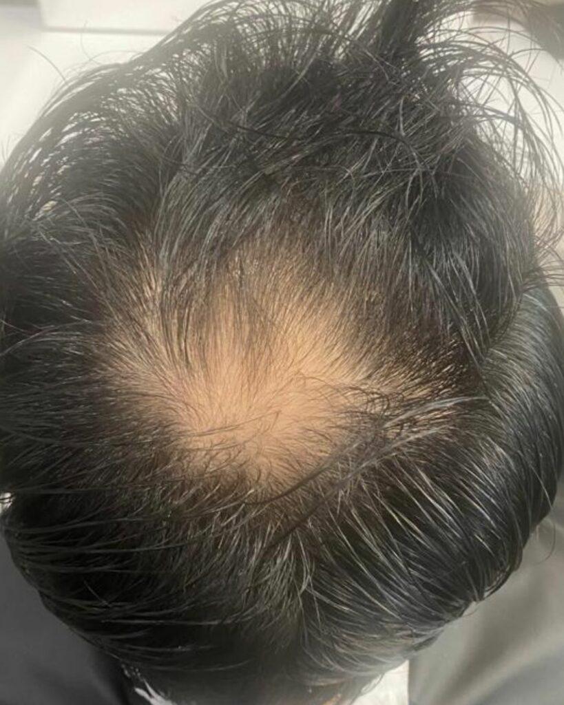 Vorher-Foto eines Mannes mit fast kahler Stelle am Kronenansatz im Hinterkopf vor Azerum-Behandlung. | Azerum Hair