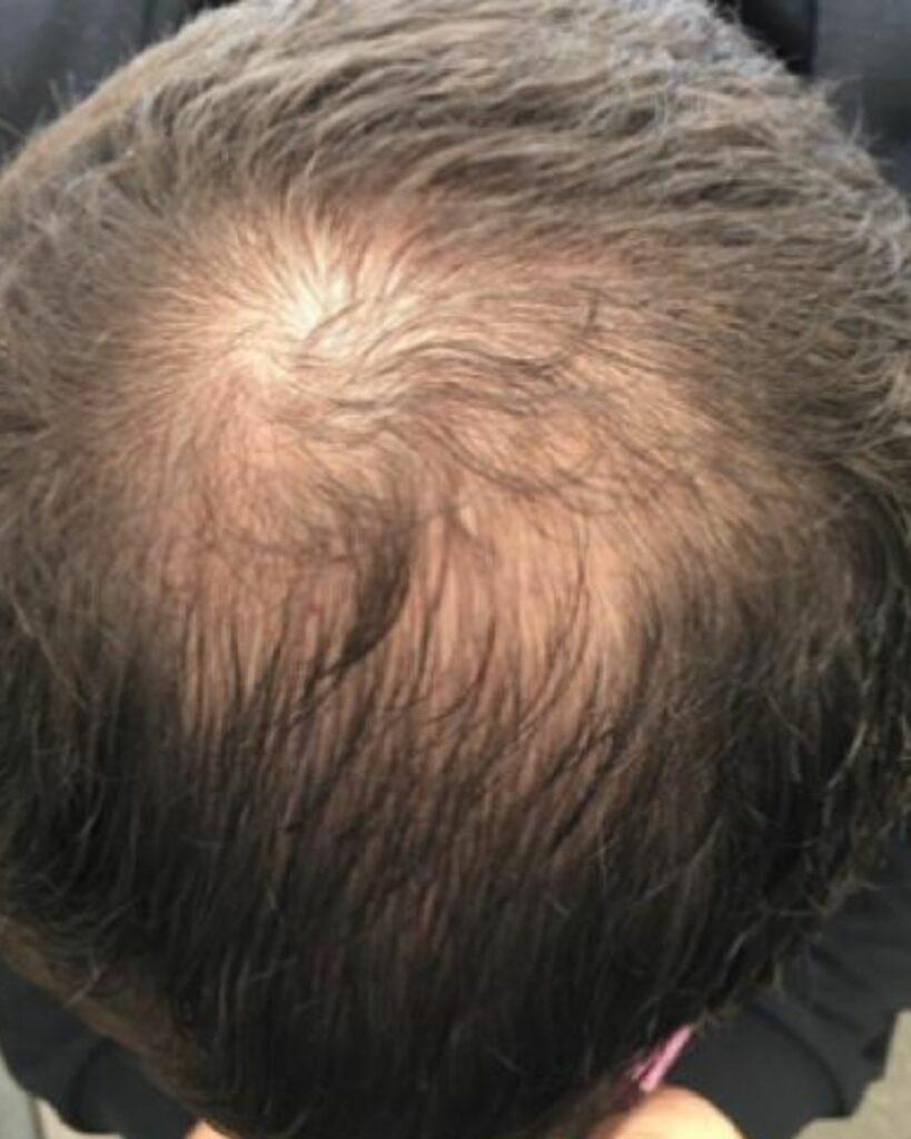 Mann mit signifikantem Haarverlust am Oberkopf und Hinterkopf vor der Anwendung von Azerum. | Azerum Hair