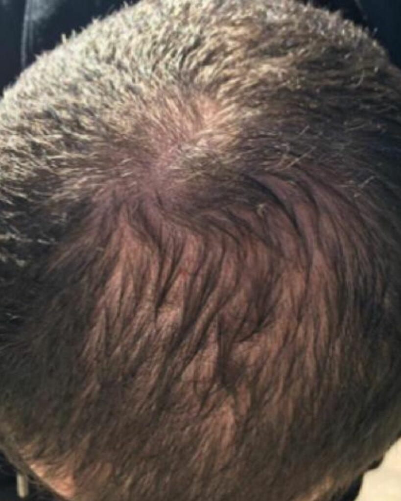 Deutlicher Haarwachstum am ehemals kahlen Bereich, dokumentiert nach der Anwendung von Azerum. | Azerum Hair